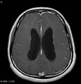 Neurofibromatosis type 2 - cranial and spinal involvement (Radiopaedia 5351-7111 Axial T1 C+ 13).jpg