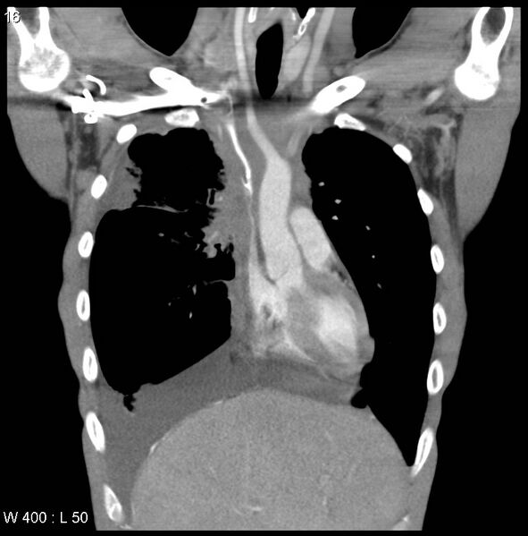 File:Non-Hodgkin lymphoma involving lung (Radiopaedia 29094-29470 C 10).jpg