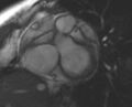 Non-compaction of the left ventricle (Radiopaedia 69436-79314 Short axis cine 189).jpg