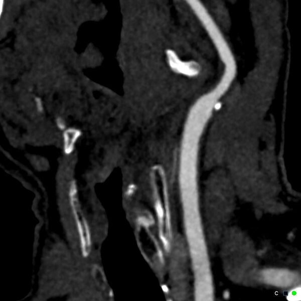 File:Non-occlusive intraluminal internal carotid artery thrombus (Radiopaedia 37751-39658 C 67).jpg
