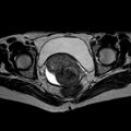 Non-puerperal uterine inversion (Radiopaedia 78343-90983 Axial T2 16).jpg