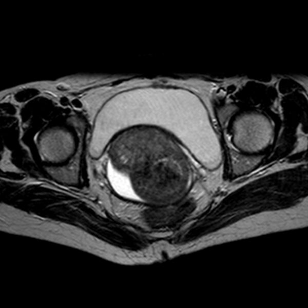 File:Non-puerperal uterine inversion (Radiopaedia 78343-90983 Axial T2 16).jpg