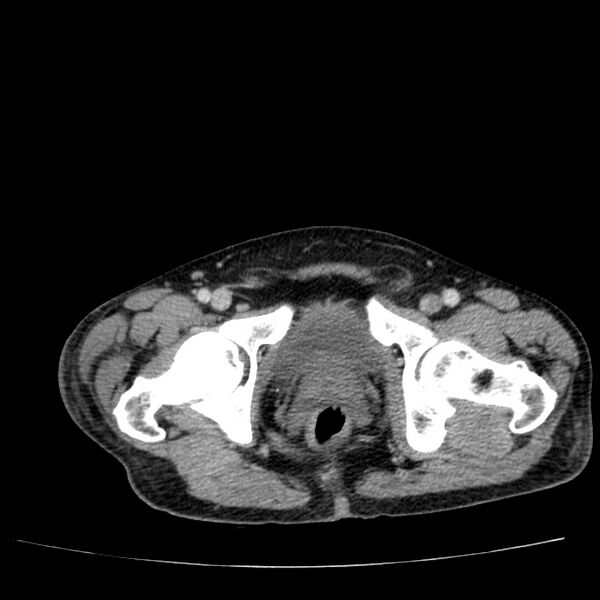 File:Non small-cell lung cancer (Radiopaedia 24467-24769 C+ delayed 116).jpg