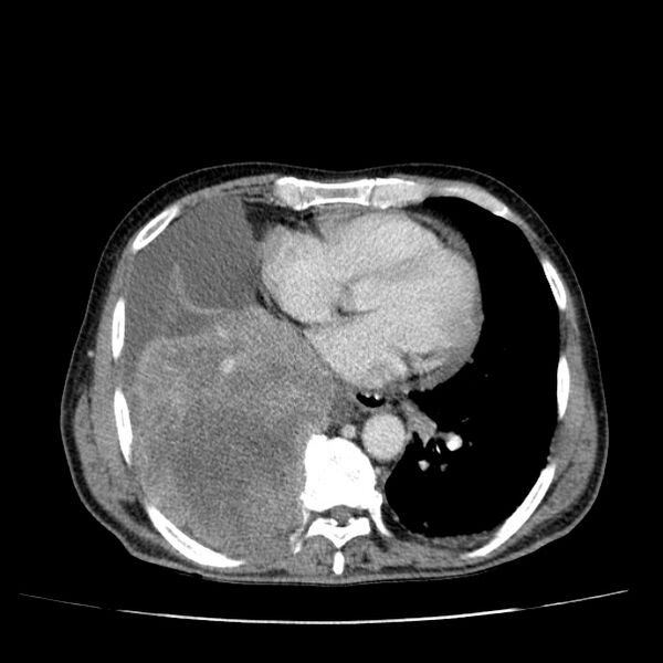 File:Non small-cell lung cancer (Radiopaedia 24467-24769 C+ delayed 40).jpg