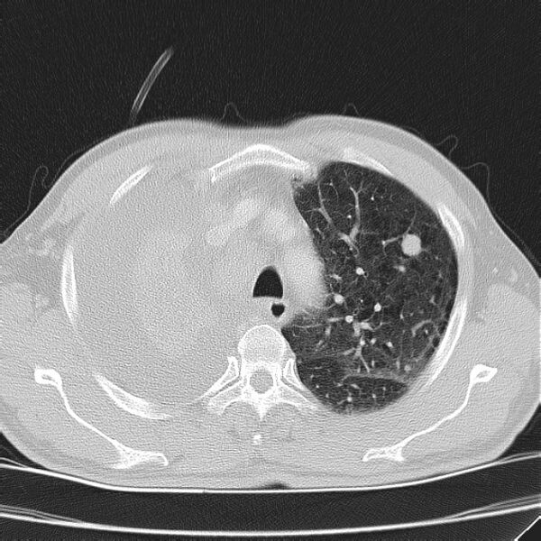 File:Non small-cell lung cancer (Radiopaedia 24467-24769 lung window 12).jpg