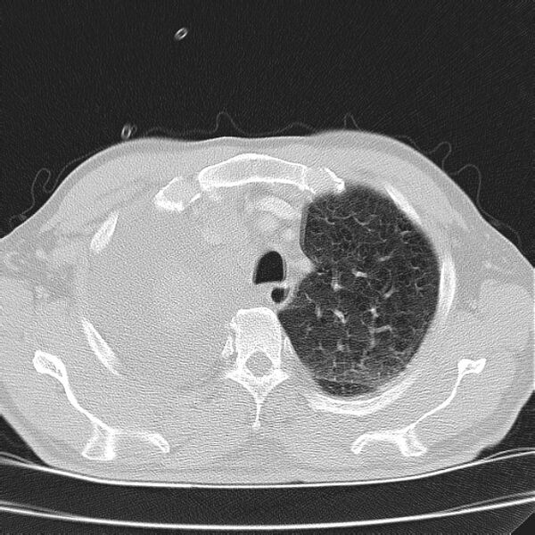 File:Non small-cell lung cancer (Radiopaedia 24467-24769 lung window 9).jpg