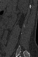 Normal CT lumbar spine (Radiopaedia 53981-60118 Sagittal bone window 84).jpg
