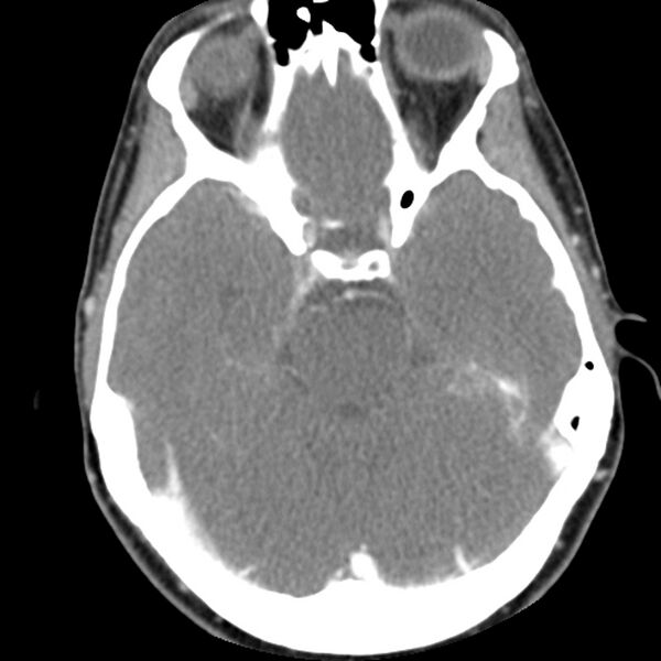 File:Normal CT of the neck (Radiopaedia 14575-14500 Axial C+ 5).jpg