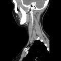 Normal CT of the neck (Radiopaedia 14575-14500 Sagittal C+ 14).jpg