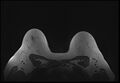 Normal breast MRI - dense breasts (Radiopaedia 80454-93850 Axial T1 181).jpg