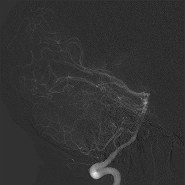 File:Normal cerebral angiogram (four vessel DSA) (Radiopaedia 41708-44649 R 11).png