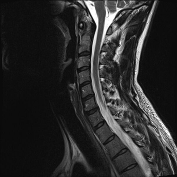 File:Normal cervical spine MRI (Radiopaedia 38418-40496 Sagittal T2 6).jpg