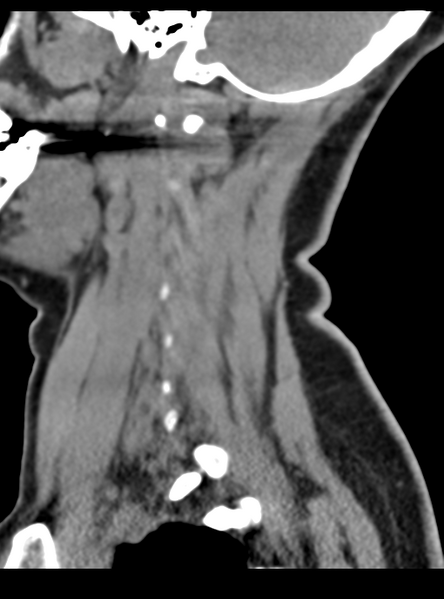 File:Normal cervical spine MRI (including Dixon) (Radiopaedia 42762-45926 C 12).png