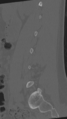 Normal lumbar spine CT (Radiopaedia 46533-50986 Sagittal bone window 71).png