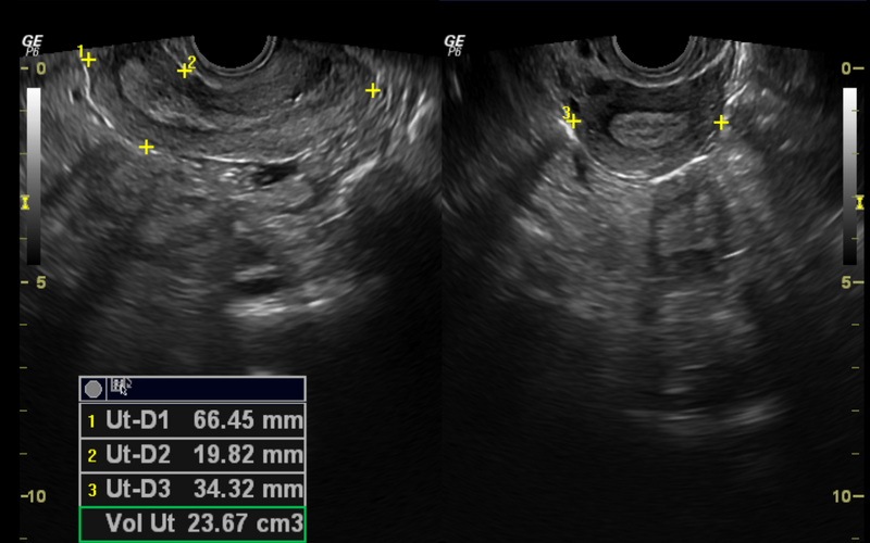 File:Normal pelvic ultrasound - transvaginal (Radiopaedia 31750-32684 E 1).png