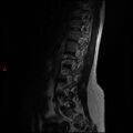 Normal spine MRI (Radiopaedia 77323-89408 Sagittal T2 4).jpg