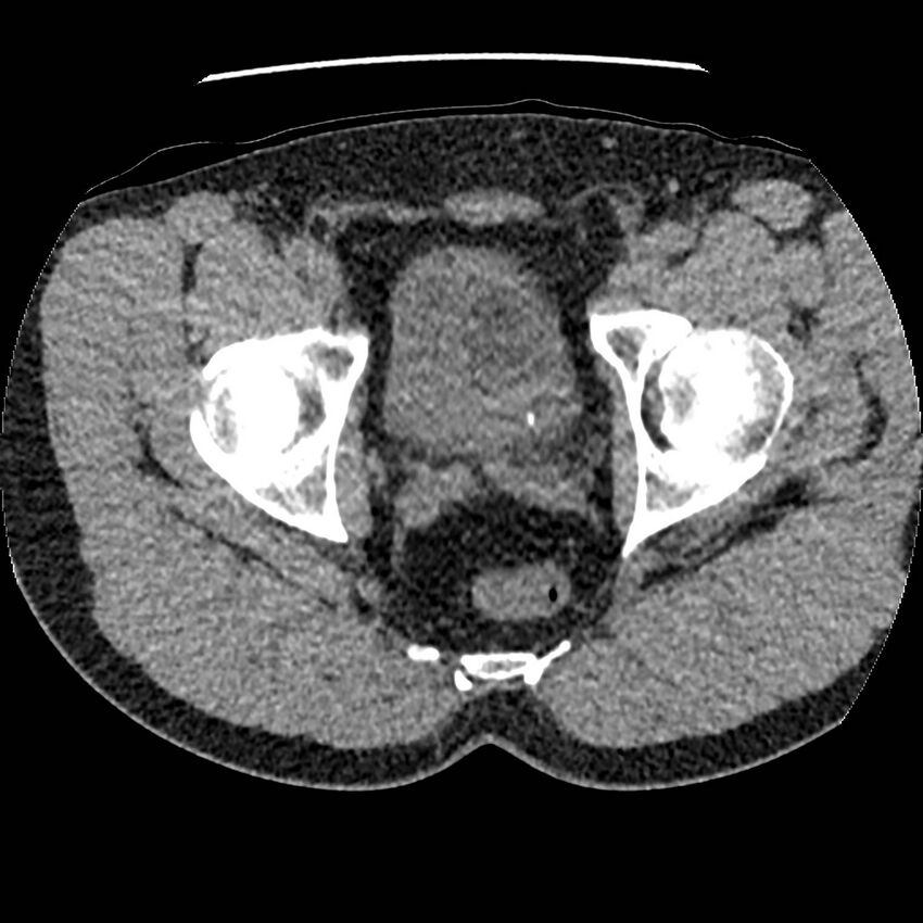 Obstructing ureteric calculus and ureteric anatomy (Radiopaedia 62730-71042 Axial non-contrast 159).jpg