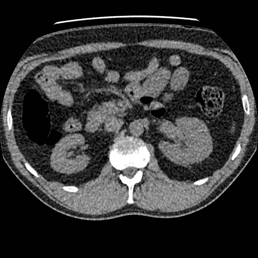 Obstructing ureteric calculus and ureteric anatomy (Radiopaedia 62730-71042 Axial non-contrast 36).jpg
