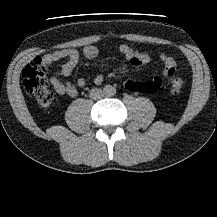 Obstructing ureteric calculus and ureteric anatomy (Radiopaedia 62730-71042 Axial non-contrast 77).jpg