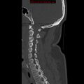 Occipital condyle fracture (Radiopaedia 18366-18208 Sagittal bone window 23).jpg