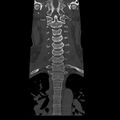 Occipital condyle fracture (Radiopaedia 31755-32691 Coronal bone window 12).jpg