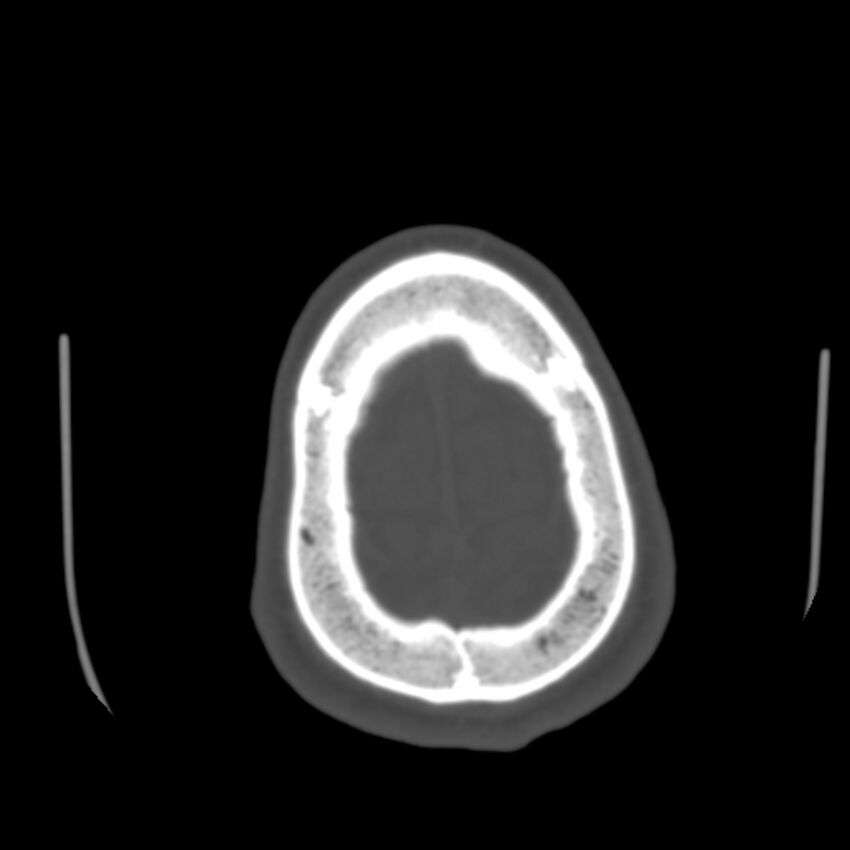 Occipital spur - asymptomatic (Radiopaedia 87753-104201 Axial bone window 194).jpg