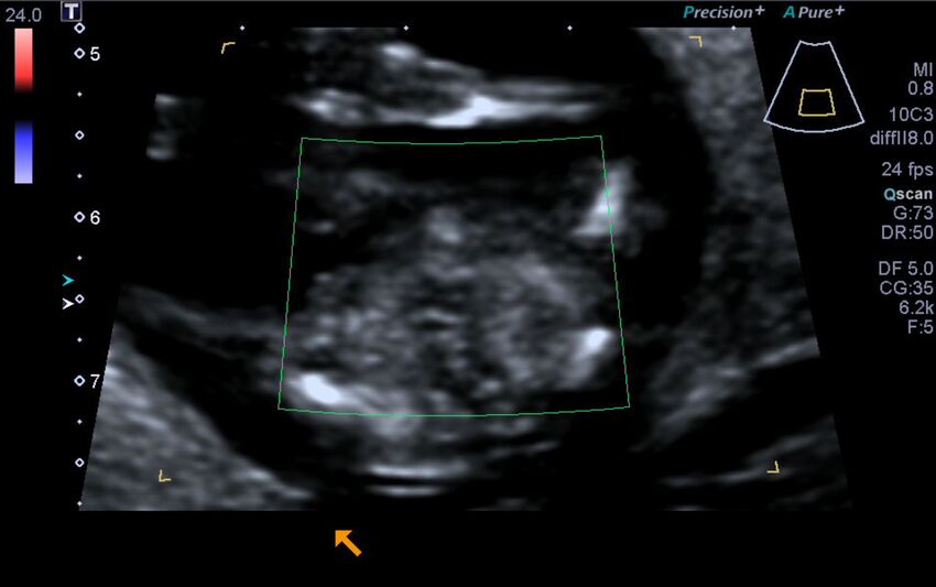1st trimester nuchal-morphology ultrasound (Radiopaedia 44706-48477 Heart views cine with colour 207).jpg