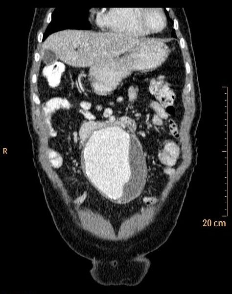 File:Abdominal aortic aneurysm (Radiopaedia 25985-26121 Coronal C+ arterial phase 3).jpg