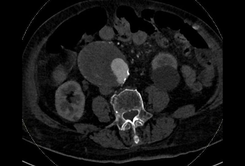 File:Abdominal aortic aneurysm with thrombus fissuration (Radiopaedia 73192-83919 Axial C+ arterial phase 120).jpg