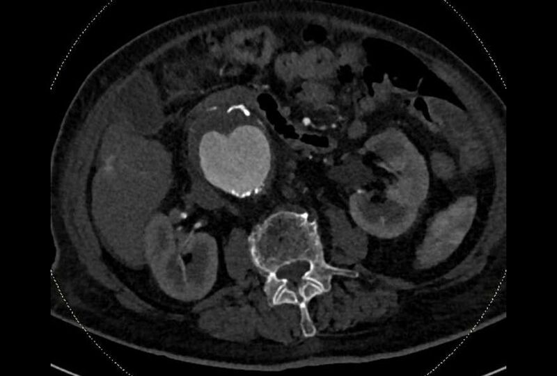 File:Abdominal aortic aneurysm with thrombus fissuration (Radiopaedia 73192-83919 Axial C+ arterial phase 73).jpg
