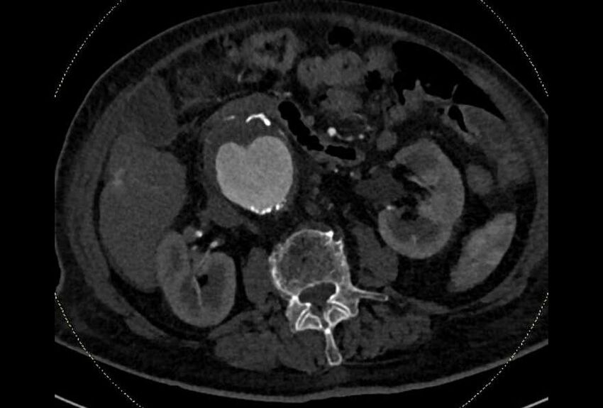 Abdominal aortic aneurysm with thrombus fissuration (Radiopaedia 73192-83919 Axial C+ arterial phase 73).jpg
