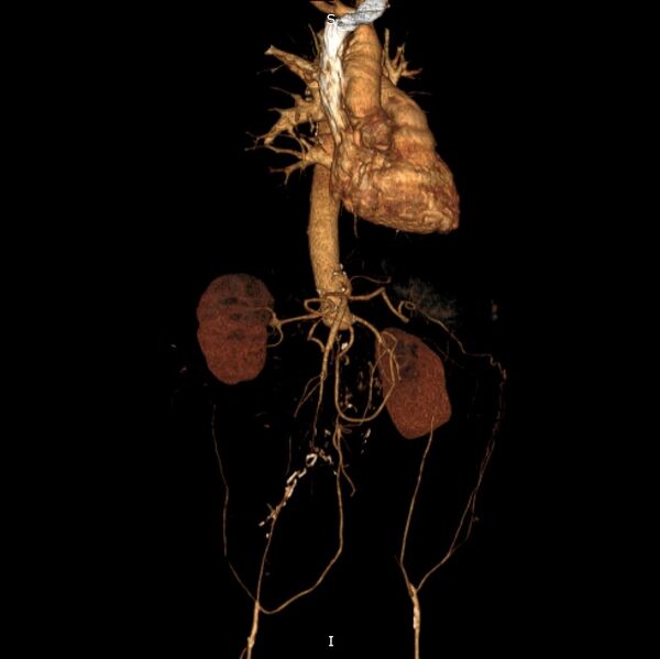 File:Abdominal aortic interposition tube graft and aneurysm thrombosis (Radiopaedia 71438-81857 3D VRT C+ arterial phase 16).jpg