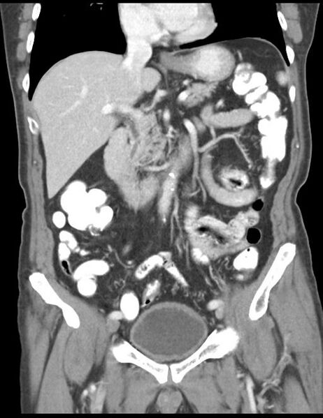 File:Abdominal wall metastasis from colorectal carcinoma (Radiopaedia 31016-31717 Coronal C+ portal venous phase 22).jpg
