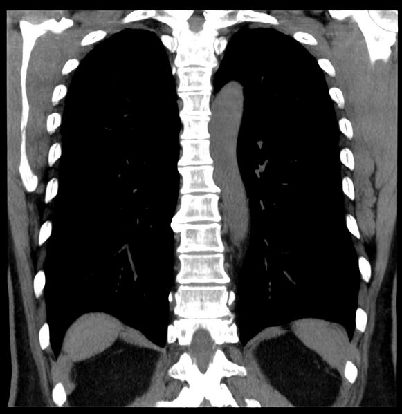 File:Aberrant right subclavian artery (Radiopaedia 40967-43680 Coronal non-contrast 31).jpg