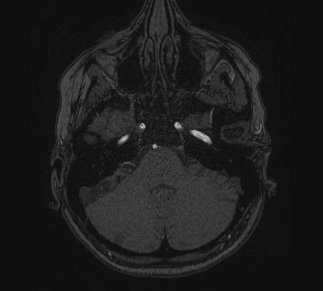 File:Accessory middle cerebral artery and ICA aneurysm (Radiopaedia 22656-22674 MRA 1).jpg