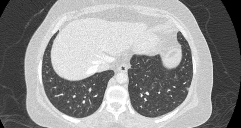 File:Accessory right inferior hepatic vein (Radiopaedia 65245-74259 Axial lung window 62).jpg