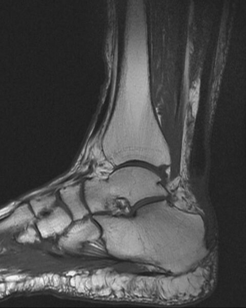 File:Achilles tendon tear (Radiopaedia 2572-6268 Sagittal T1 1).jpg