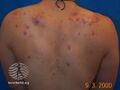 Acne affecting the back images (DermNet NZ acne-acne-back-185).jpg
