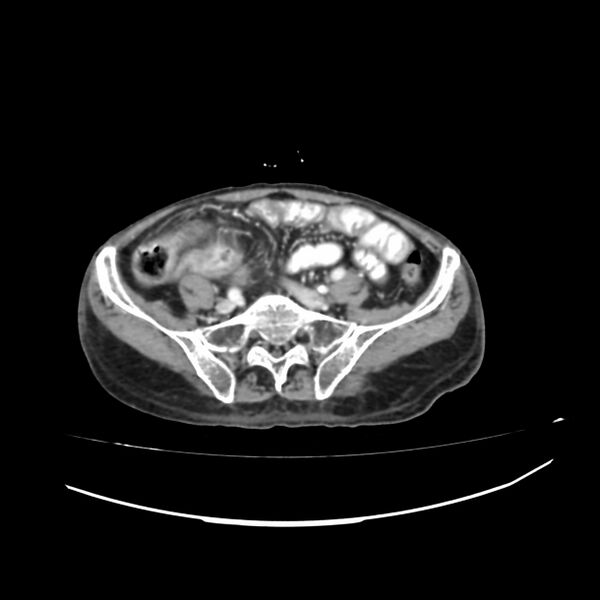 File:Acute-on-chronic Crohn disease with enteroenteric fistula (Radiopaedia 66686-75987 B 40).jpg
