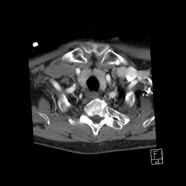 File:Acute ICA ischemic penumbra due to high-grade CCA stenosis (CT perfusion) (Radiopaedia 72038-82530 Axial C+ arterial phase 68).jpg