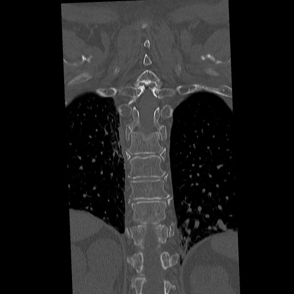 File:Acute and chronic vertebral compression fractures (Radiopaedia 31608-32494 Coronal bone window 32).jpg