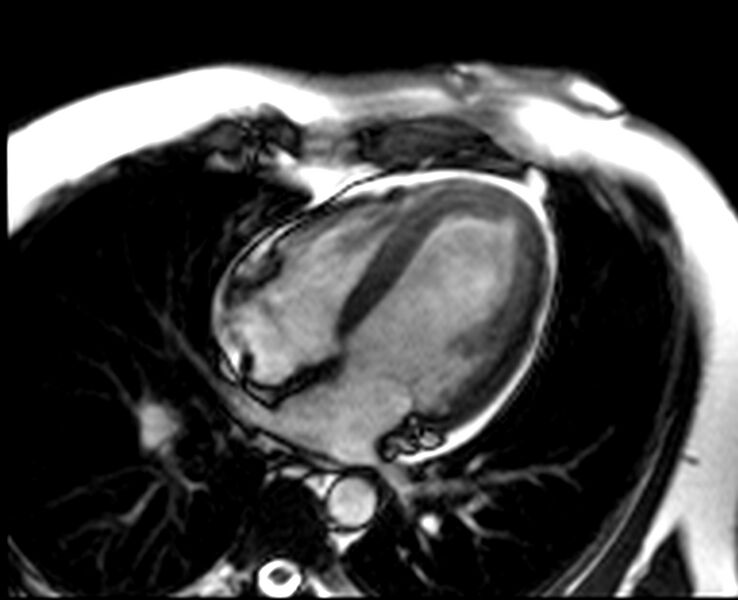 File:Acute anteroseptal myocardial infarction (Radiopaedia 68409-77944 Four chambers view SSFP cine 2).jpg