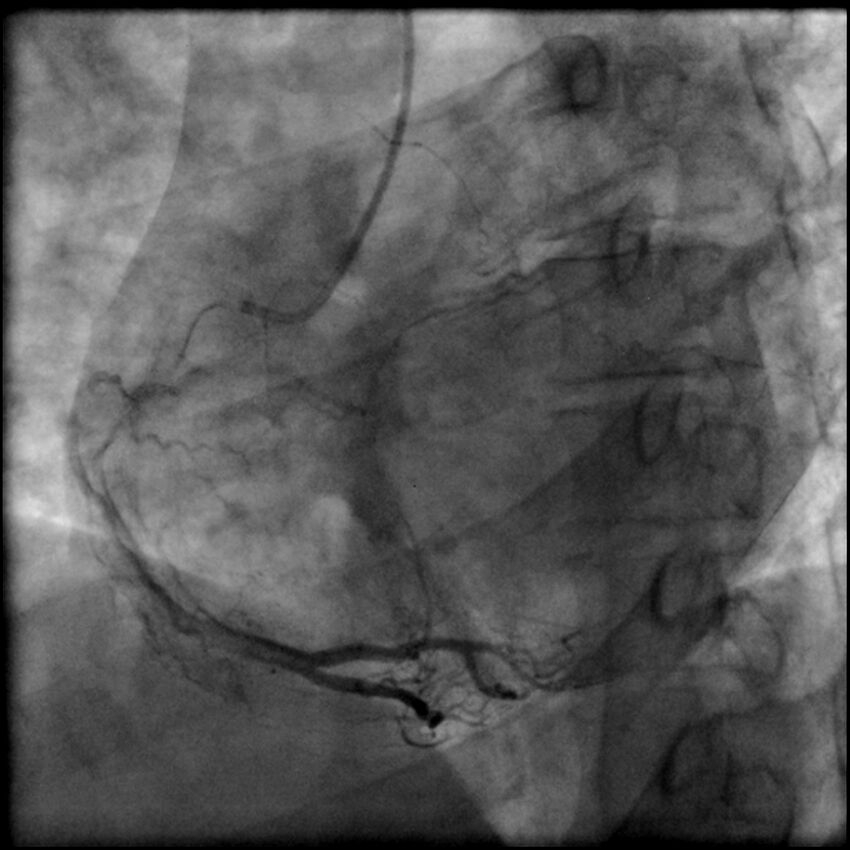 Acute anteroseptal myocardial infarction (Radiopaedia 68409-77946 RAO straight RCA 55).jpg