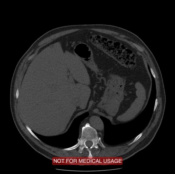 File:Acute aortic dissection - Stanford type A (Radiopaedia 40661-43285 Axial non-contrast 72).jpg