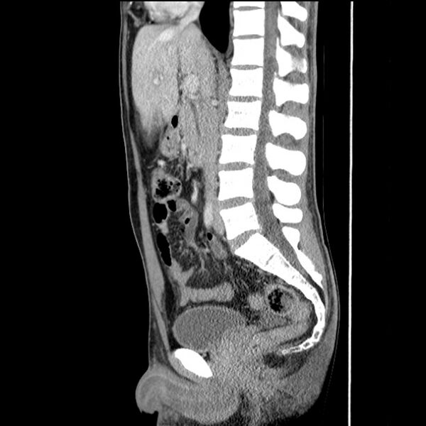 File:Acute appendicitis (Radiopaedia 27049-27227 Sagittal C+ portal venous phase 39).jpg