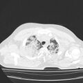 Acute aspiration pneumonitis (Radiopaedia 33605-34703 Axial lung window 21).jpg