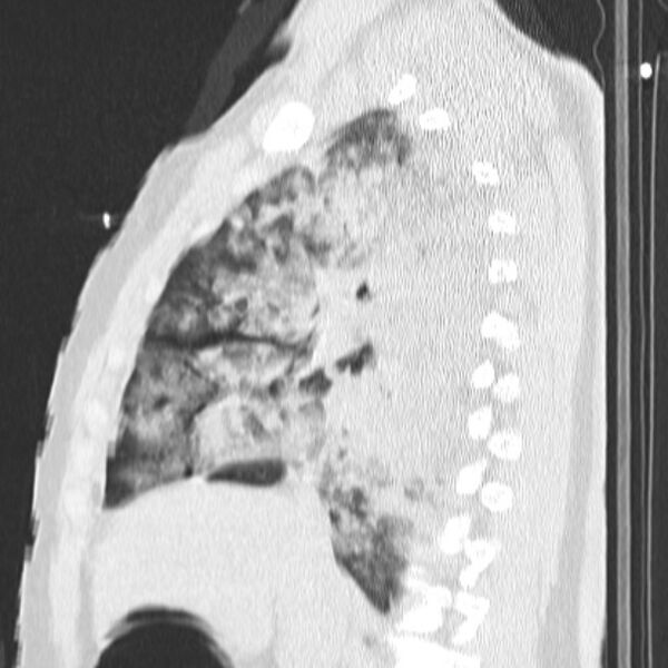File:Acute aspiration pneumonitis (Radiopaedia 33605-34703 Sagittal lung window 37).jpg