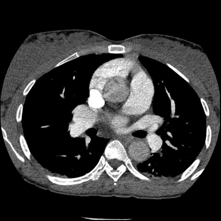 Acute chest syndrome - sickle cell disease (Radiopaedia 42375-45499 Axial C+ CTPA 86).jpg