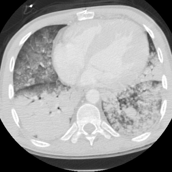 File:Acute diffuse alveolar hemorrhage (Radiopaedia 41323-44158 Axial lung window 42).jpg