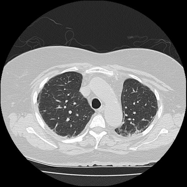File:Acute interstitial pneumonitis (Radiopaedia 45404-49452 Axial lung window 28).jpg